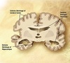 Alzheimer's_disease_brain_comparison